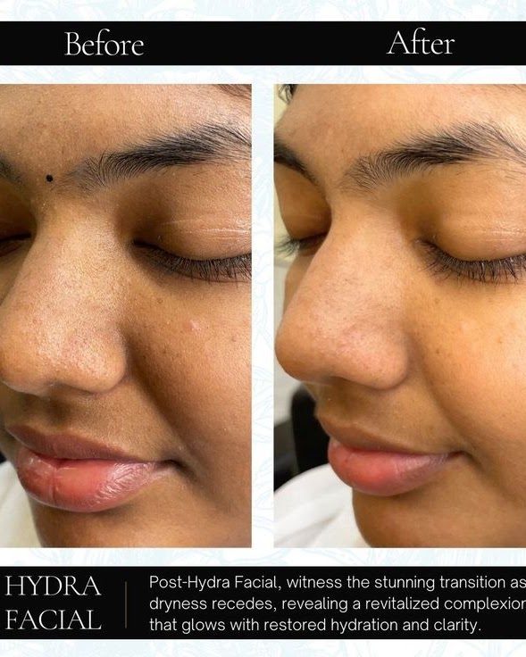 Benefits of HydraFacial