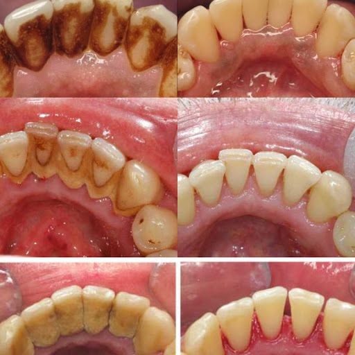 BEFORE AND AFTER