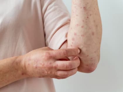 В Артемовскую ЦРБ поступила вакцина против кори