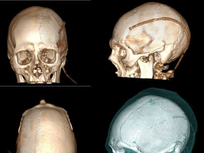 Уральские врачи восстановили кости черепа пострадавшего в ДТП мужчины при помощи 3D-моделируемого импланта