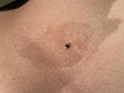В Берёзовском 109 человек подверглись укусам клещей