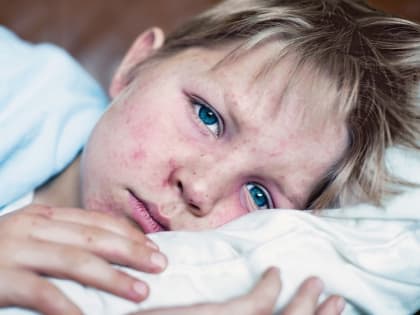 Детская чума