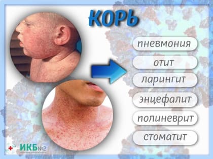 Резкий рост заболеваемости корью дагестанские медики  отмечают среди детей в 2023 году