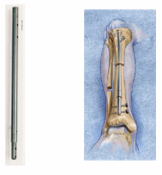 Dr. Paley Performs His First ISKD Lengthening Nail