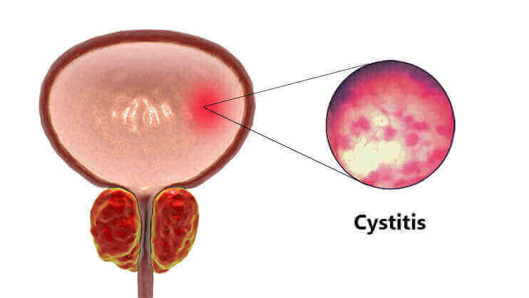 cystitis