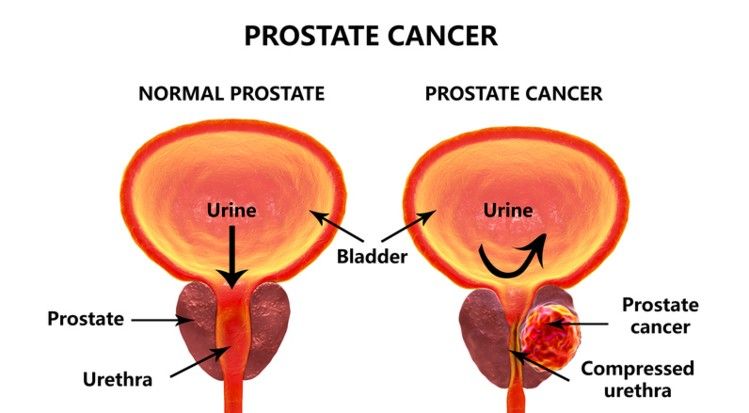 prostate cancer treatment in Noida