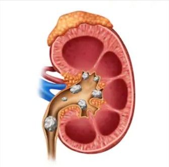 kidney stone treatment in Greater Noida