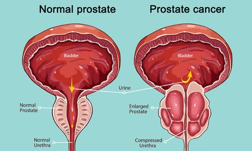 rmn multiparametric prostata