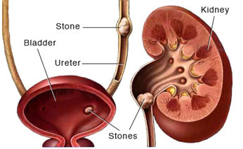 kidney stone treatment in Ghaziabad