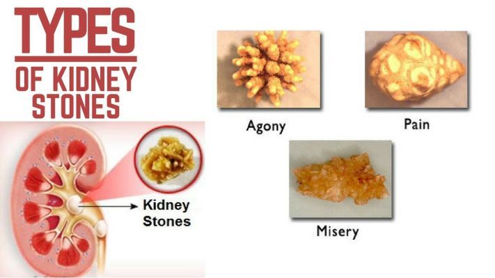 kidney stones pain