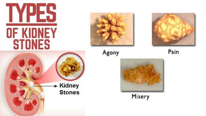 kidney stones pain treatment