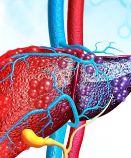 മെലിഞ്ഞവരിലും കരളില്‍ കൊഴുപ്പടിയും; വില്ലനായി ലീന്‍ ഫാറ്റി ലിവര്‍