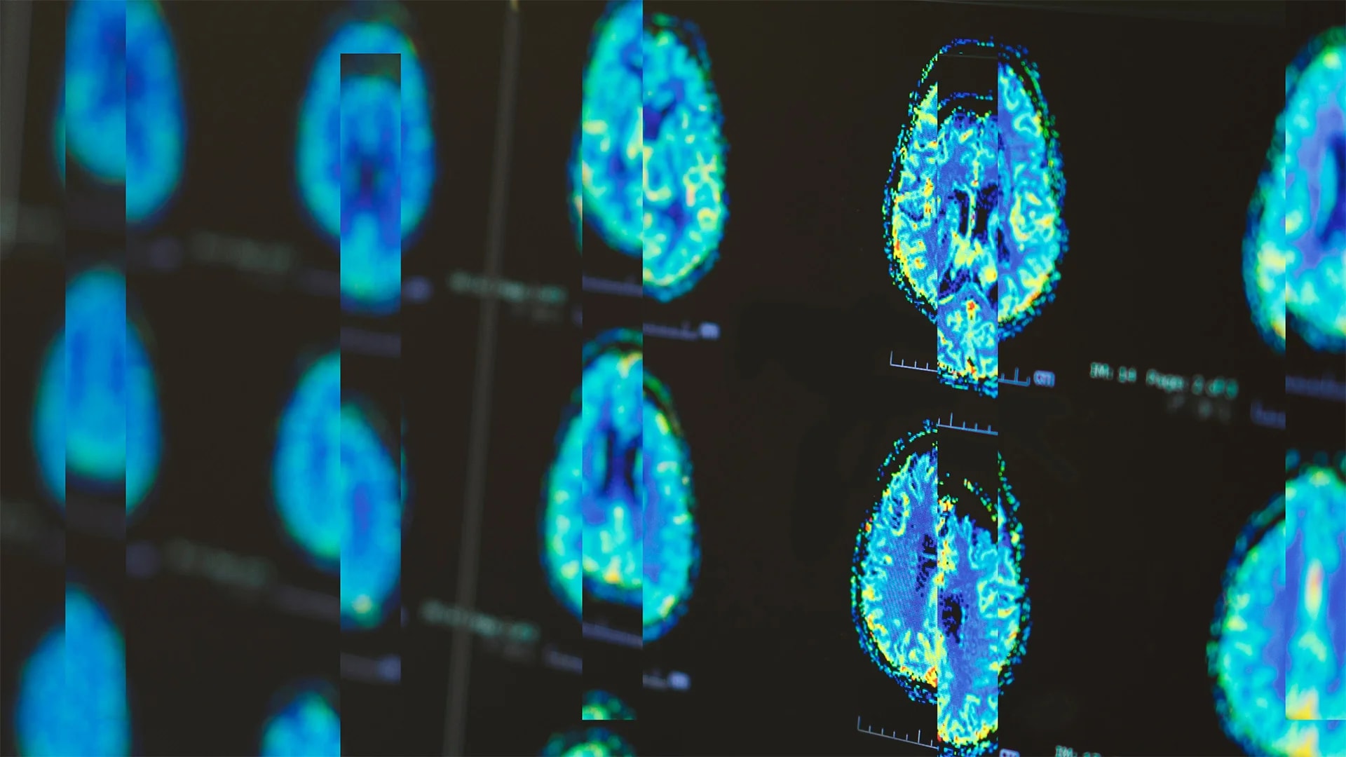 L'impact de l'ADHD sur le corps : une nouvelle perspective pour le secteur du transport
