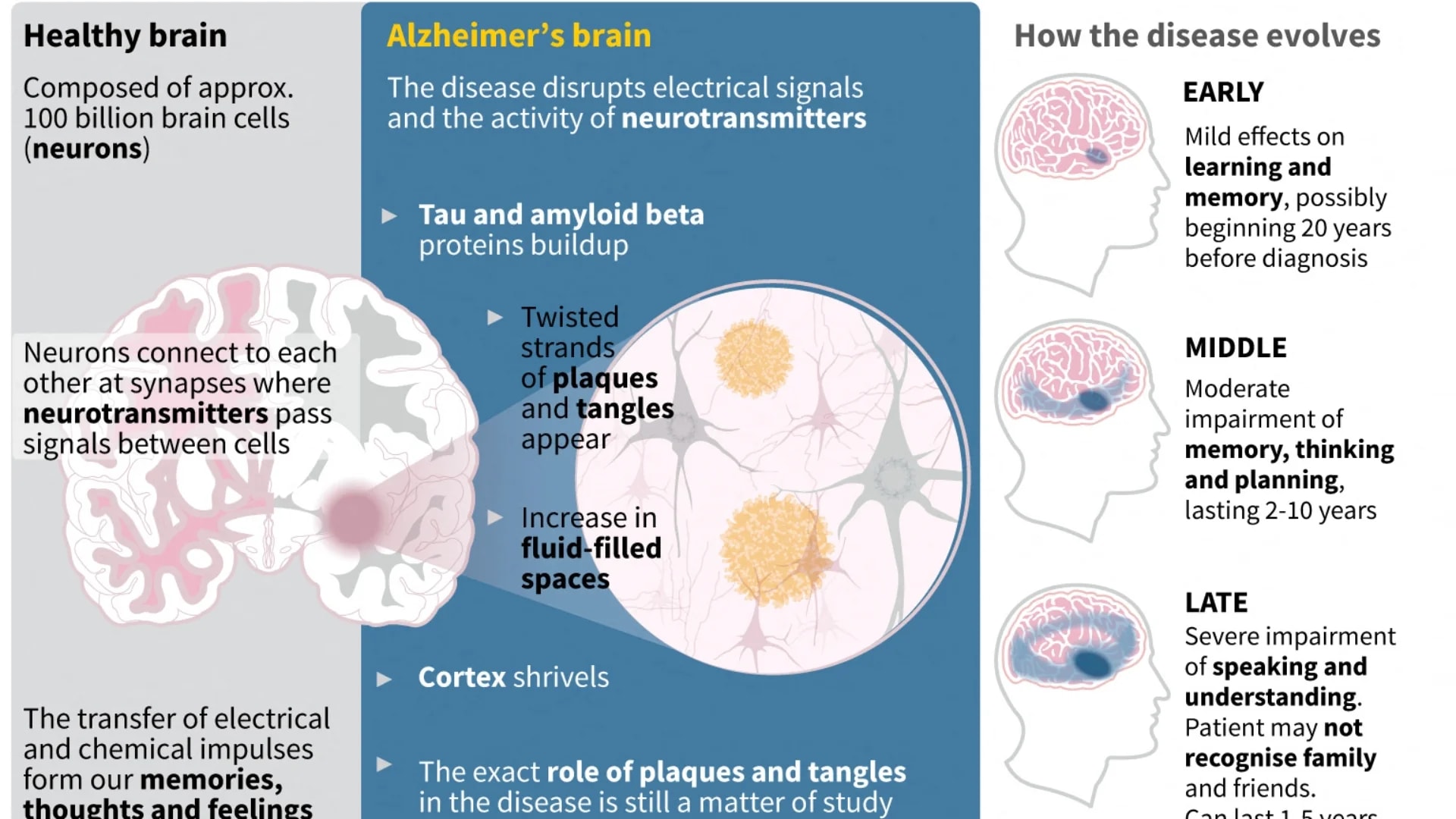 Une Découverte Prometteuse pour Anticiper les Risques d'Alzheimer