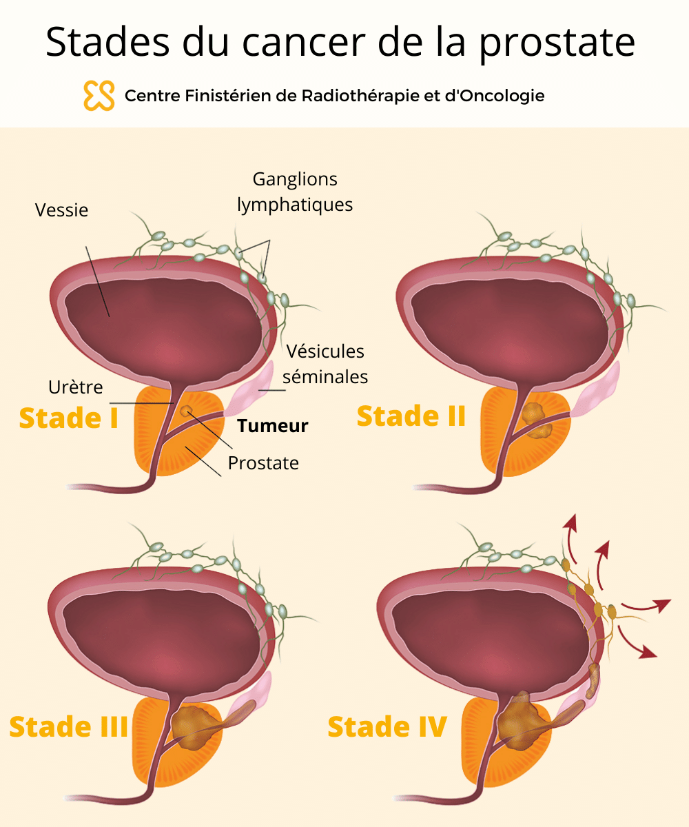 stade cancer prostate 1 2 3 4