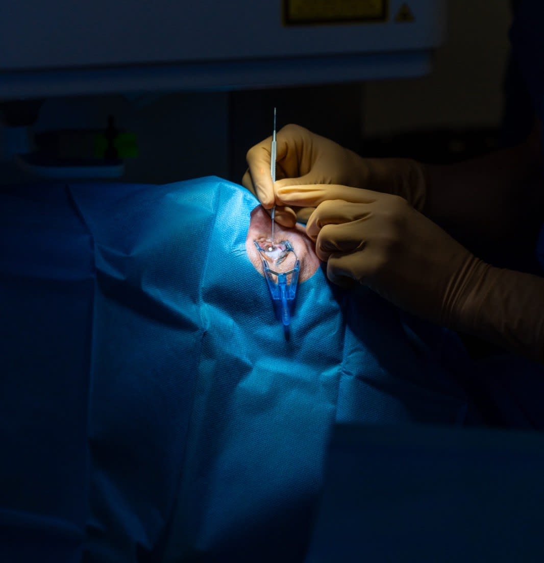 Opération des yeux dans le centre de chirurgie réfractive de Toulon