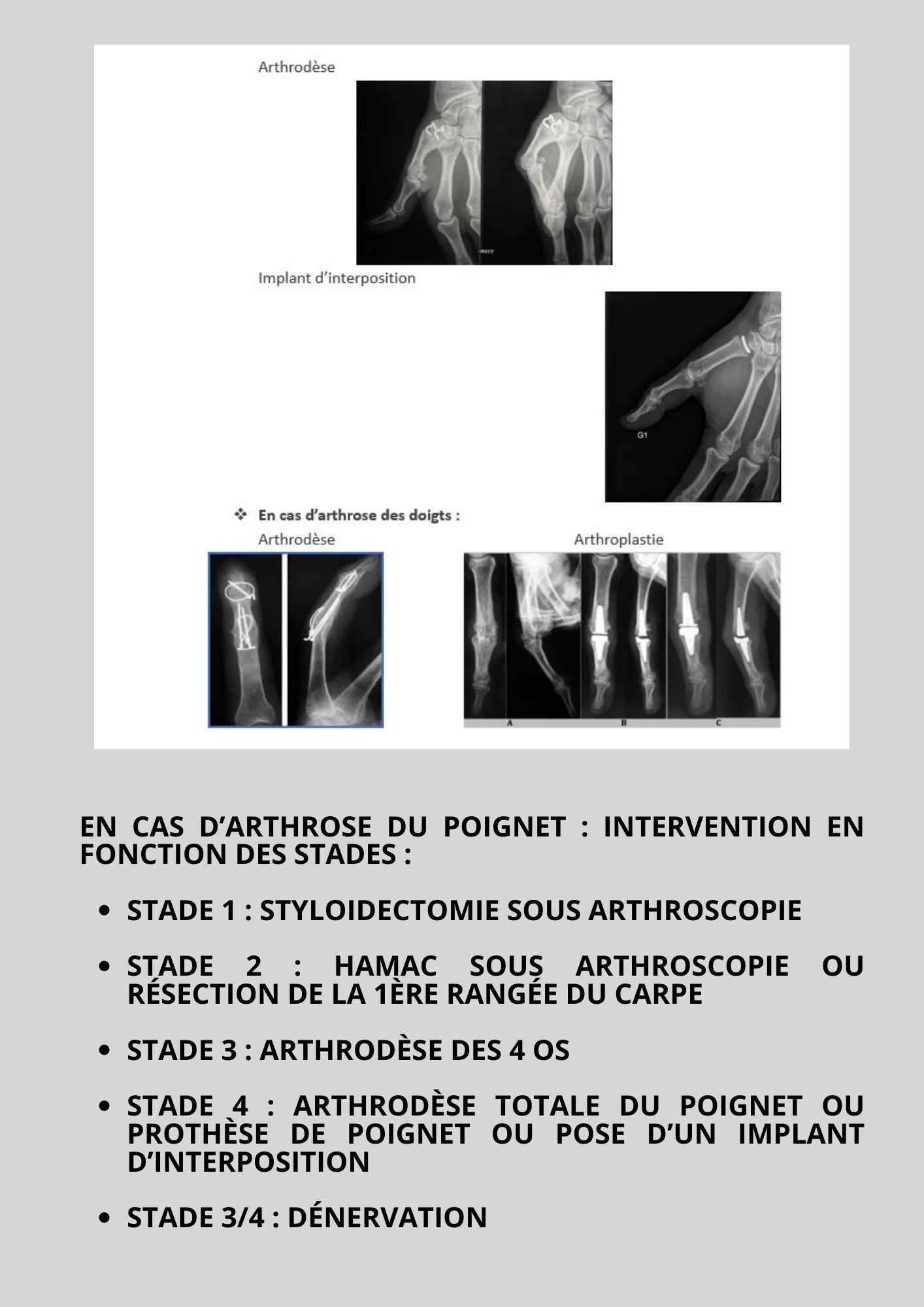 ARTHROSE DU POIGNET ET DES DOIGTS, POSSIBILITÉS THÉRAPEUTIQUES
