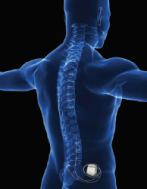 Neurosimulation