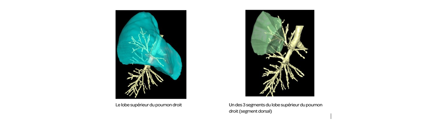 lob supérieur poumon