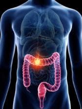 Anatomie cancer colon