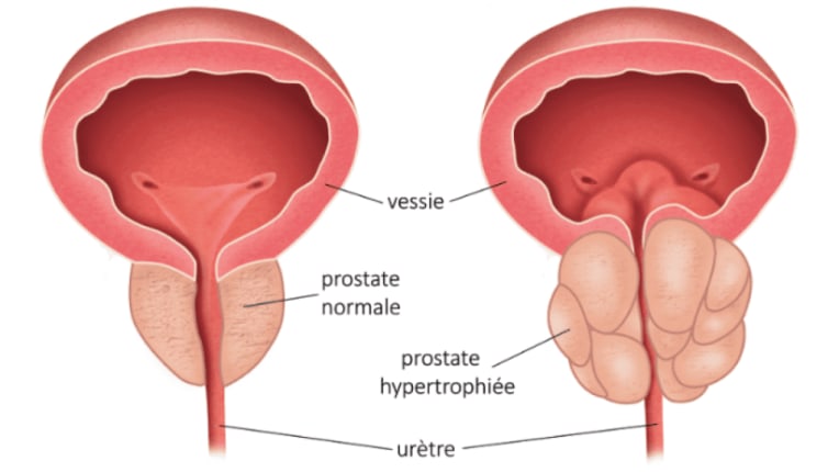 La Polyclinique Montier la Celle introduit la technique mini-invasive UroLift pour traiter l’Hypertrophie Bénigne de la Prostate 