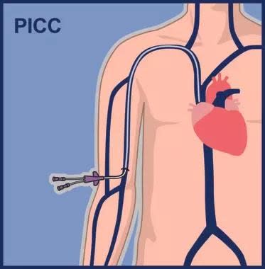 Technique de pose de CIP