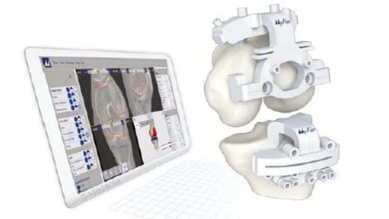Prothèse de genou : une chirurgie sur mesure grâce à la planification 3D