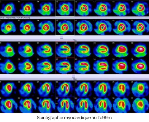 Scintigraphie myocardique au Tc99m