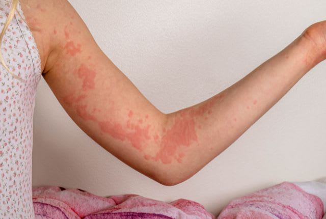 Urticaire : journée mondiale le 1er octobre 2024