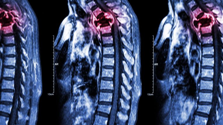 Métastase : nouvelle piste de traitement annoncée par l’Inserm