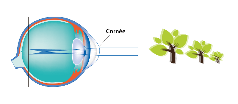 L’astigmatisme
