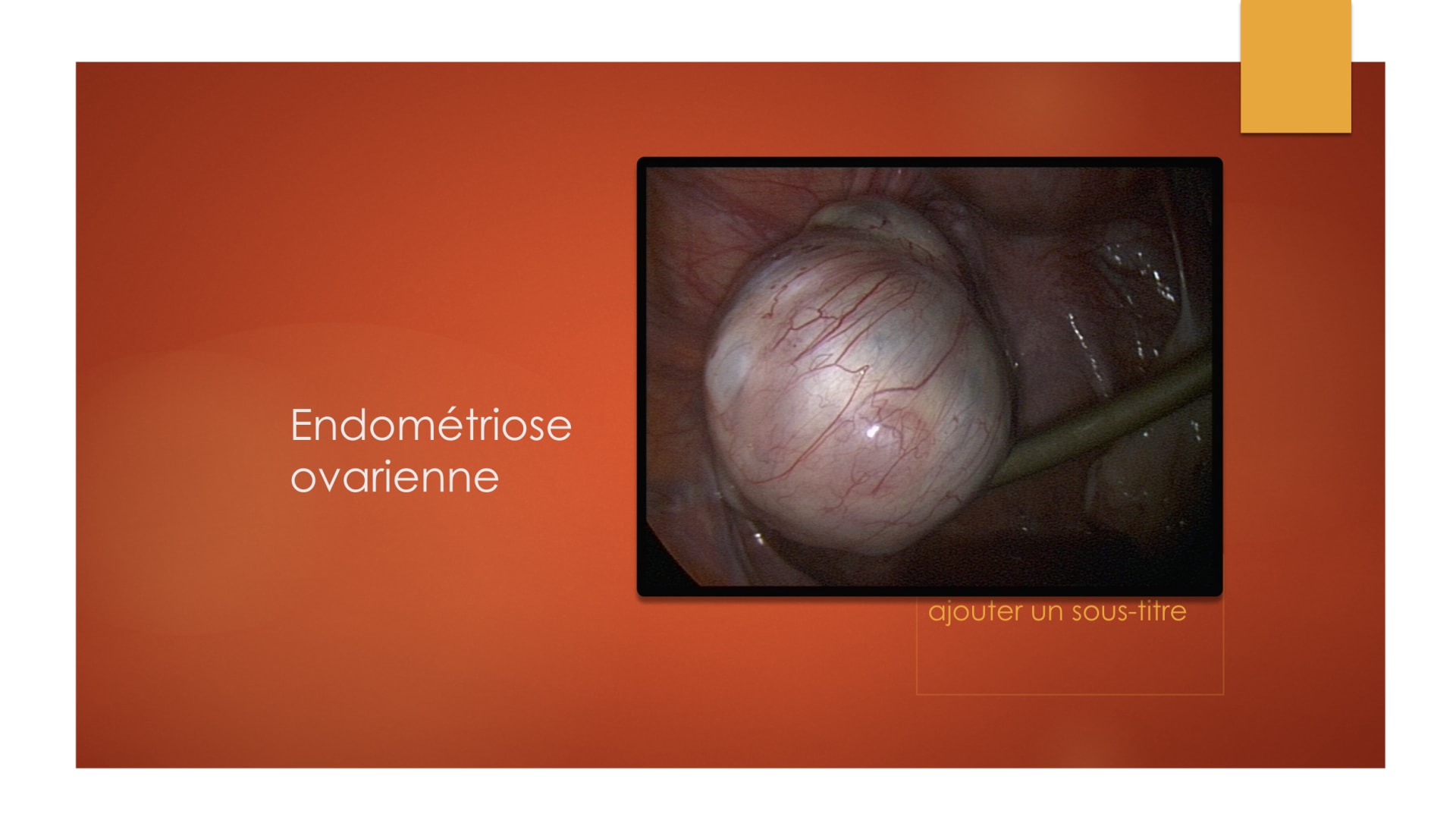 L’endométriose ovarienne