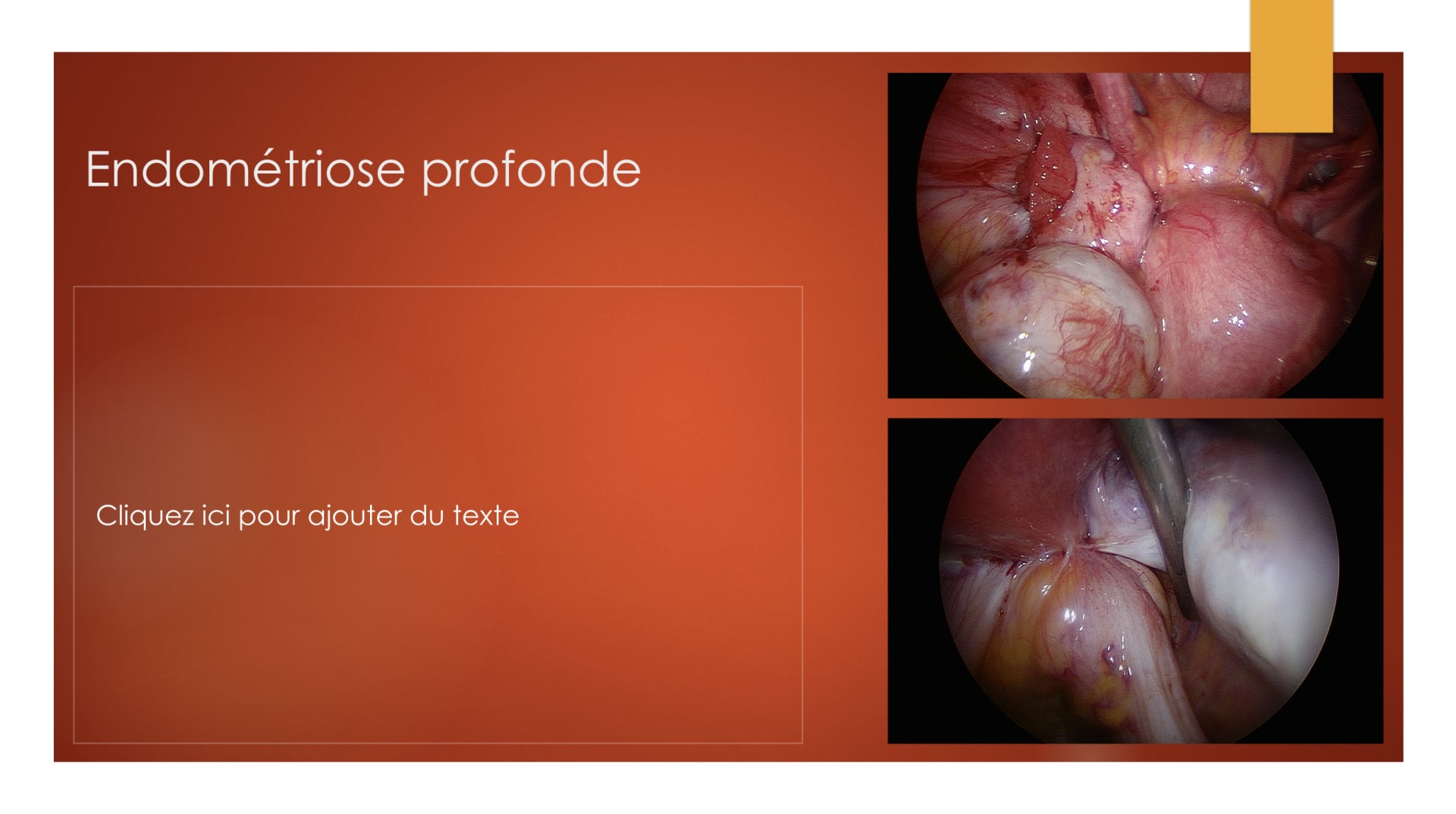 L’endométriose profonde