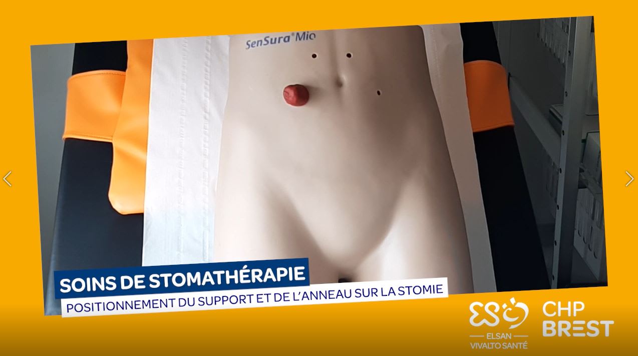 Positionnement du support et de l'anneau sur la stomie