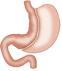 La sleeve gastrique