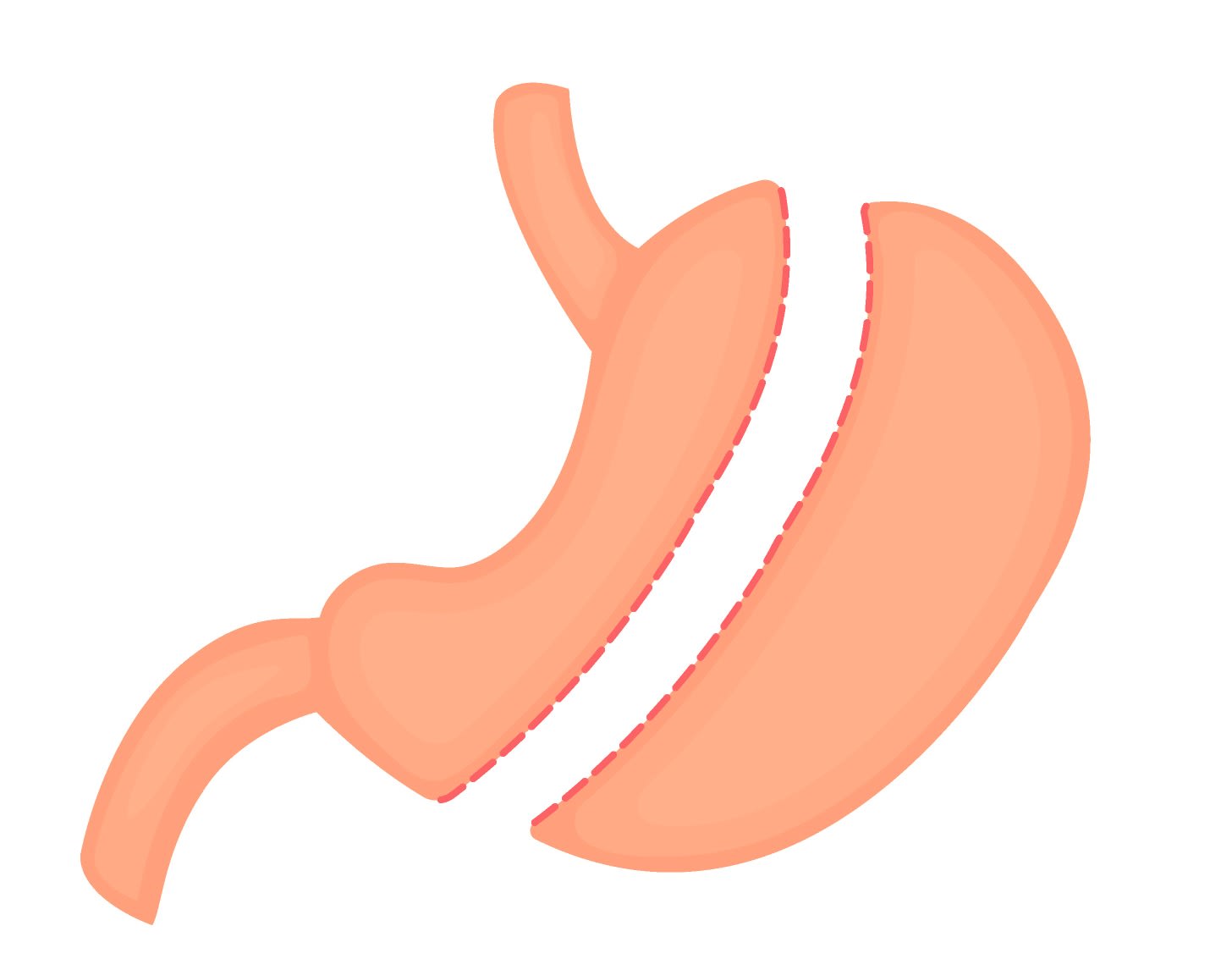 Gastrectomie ou sleeve