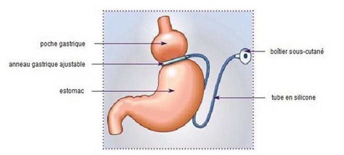 L'anneau gastrique