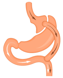 Le bypass gastrique