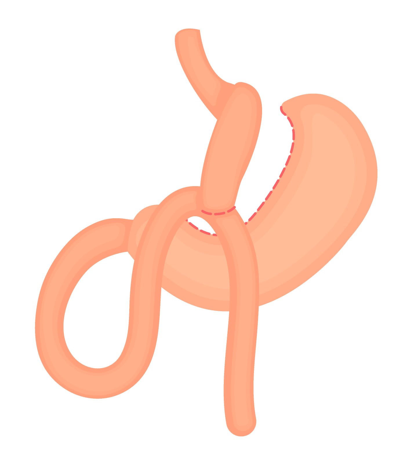 Pontage gastrique