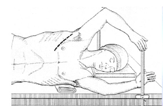 Les thoracotomies avec pariétectomie