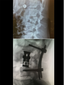 association techniques pour une fracture complexe 