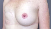 Chirurgie esthétique : une belle reconstruction du sein. Image du sein avant.