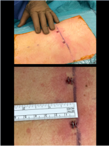 fermeture cutanee aprees expansion vertebrale