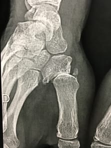 Rhizarthrose