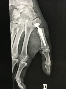 Rhizarthrose