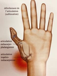 Rhizarthrose, l’arthrose du pouce