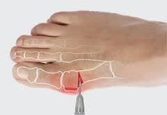 Hallux