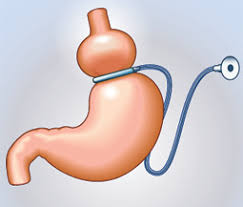 Anneau gastrique ajustable - chirurgie bariatrique - CHP Brest - Keraudren