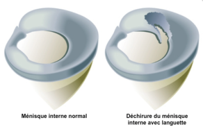 lésions méniscales languette