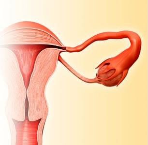 cancer ovaire thérapie